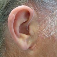 Adhesive retained prosthesis with hearing aid 