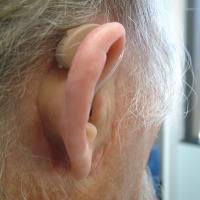 Adhesive retained prosthesis with hearing aid 